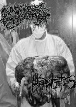 Gangrenous Erythromelalgia : Hepatitis - Gangrenous Erythromelalgia